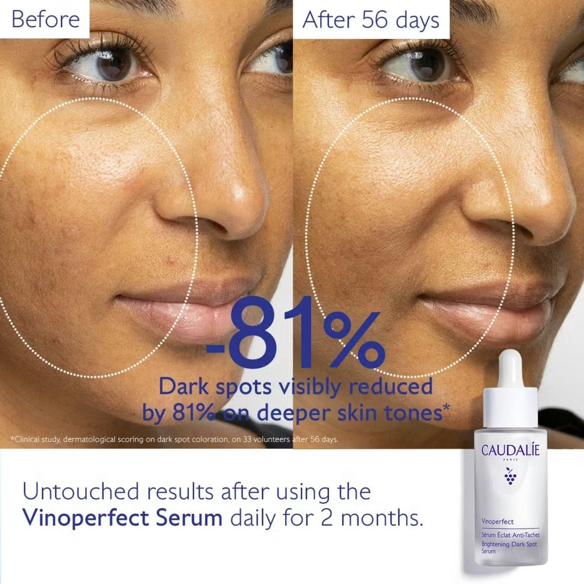 Before and after comparison of skin using Caudalie Vinoperfect Brightening Dark Spot Serum